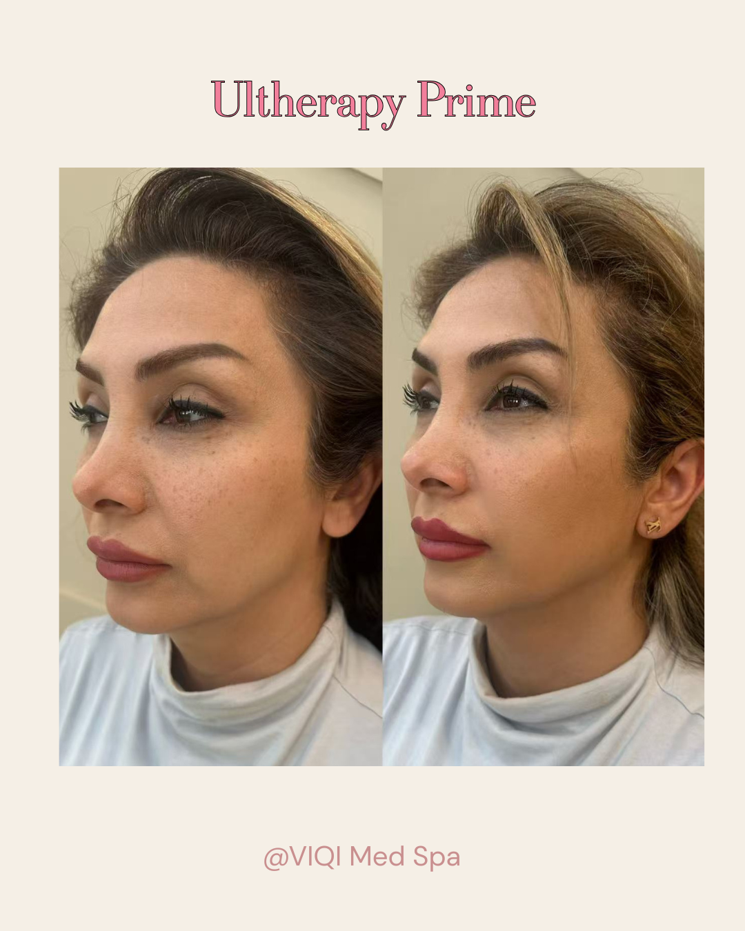 Real VIQI Ultherapy Prime Patient — Before & After. Individual results vary.