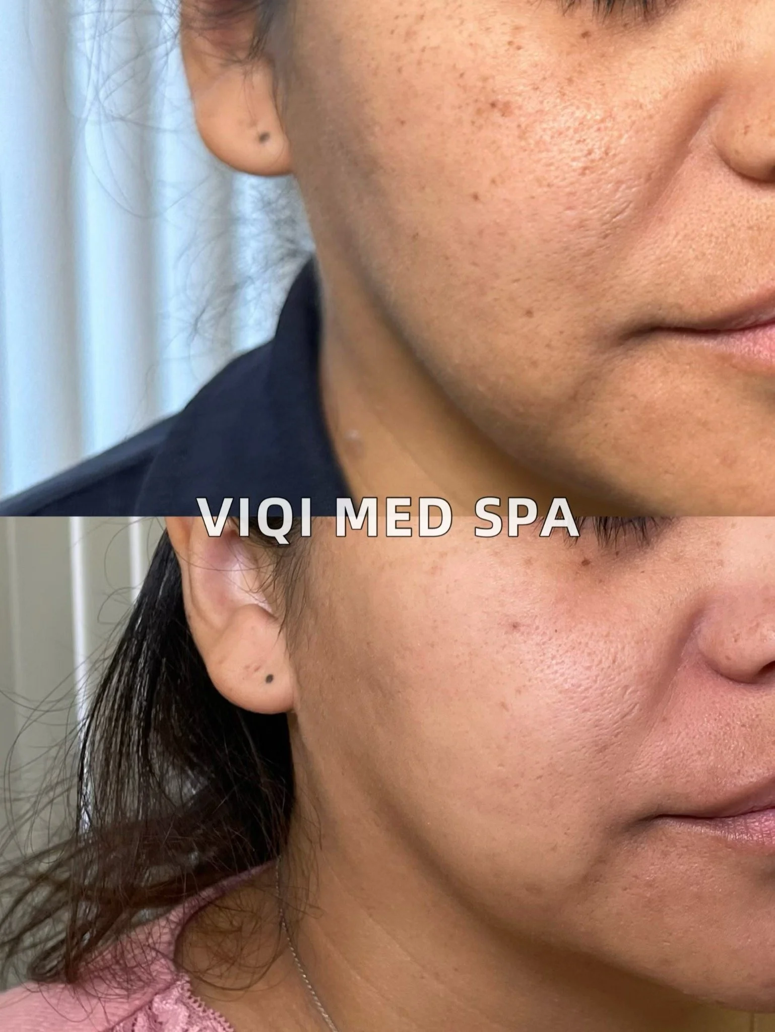 VIQI patient IPL/XPL photo comparison, alternate side view. Before above and after below. Individual results vary.