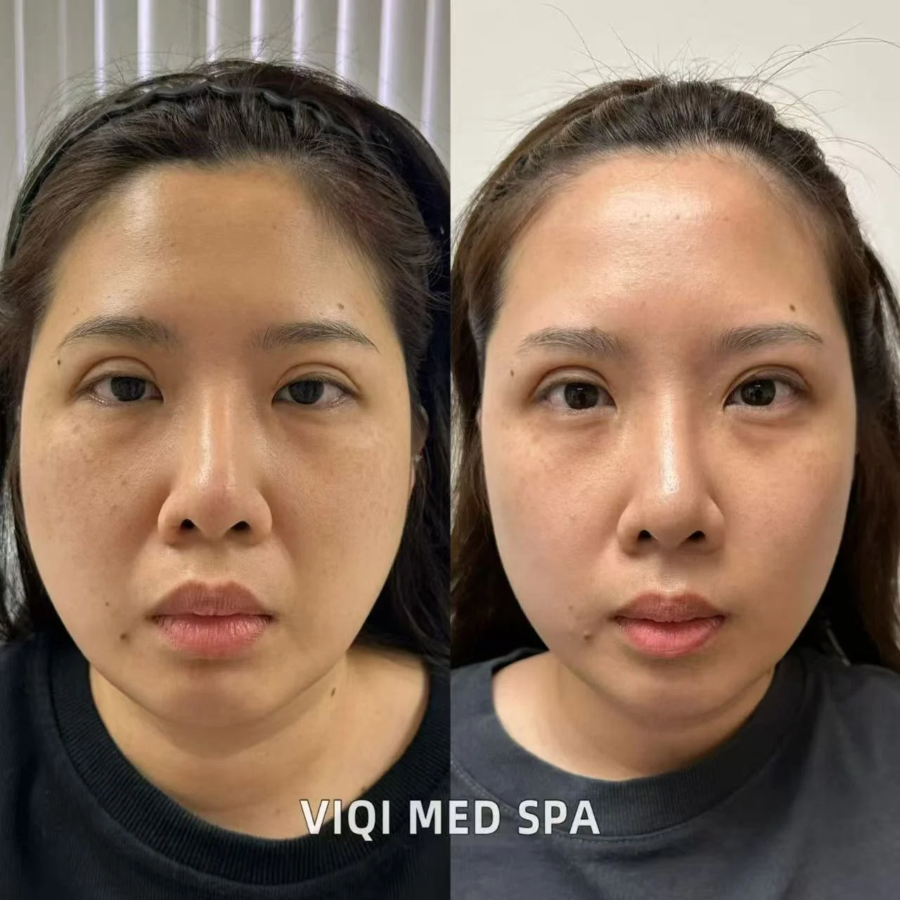 Real VIQI Ultherapy Prime Patient — Before & After. Individual results vary.