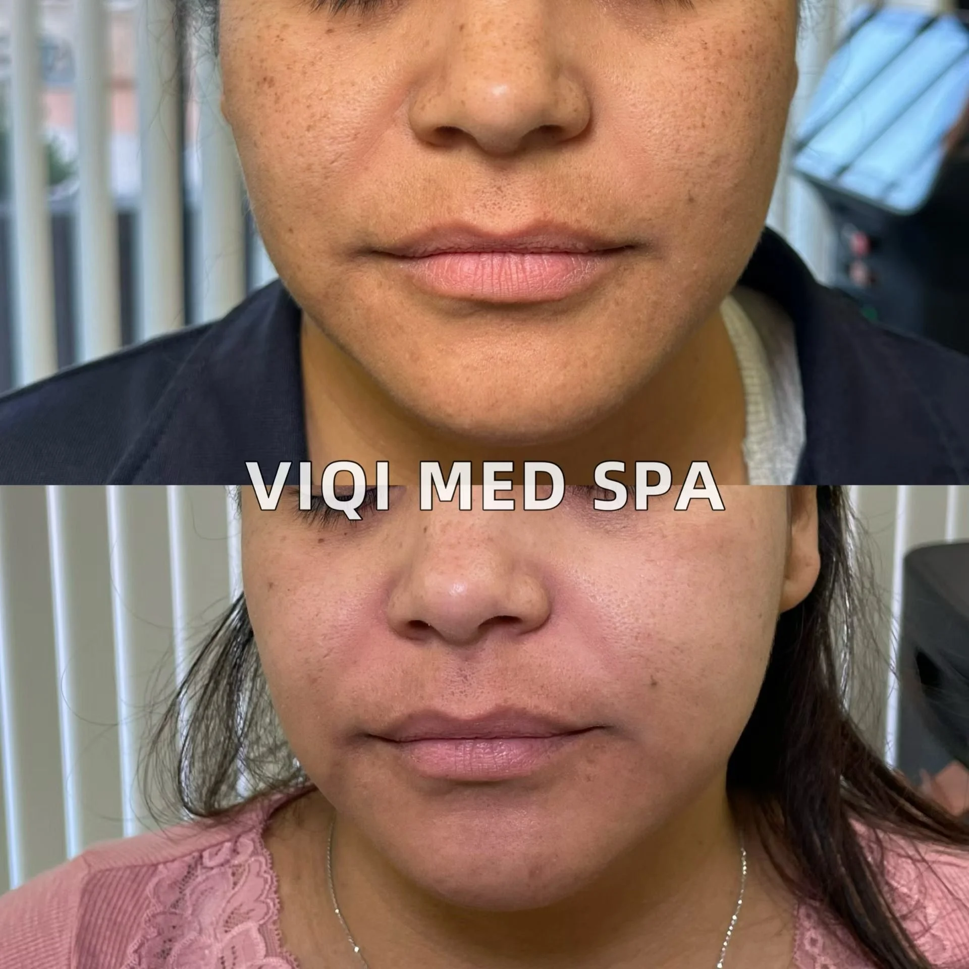 Front-view comparison of the same VIQI patient, earlier photo above and later photo below