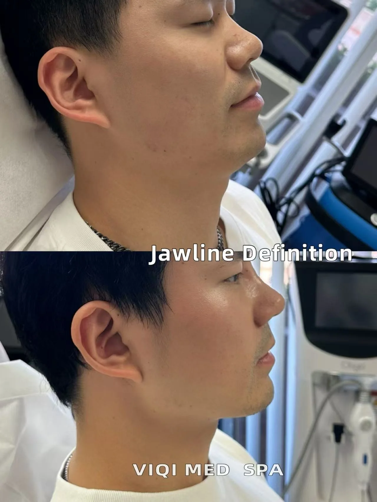 Radiesse · Jawline Definition
