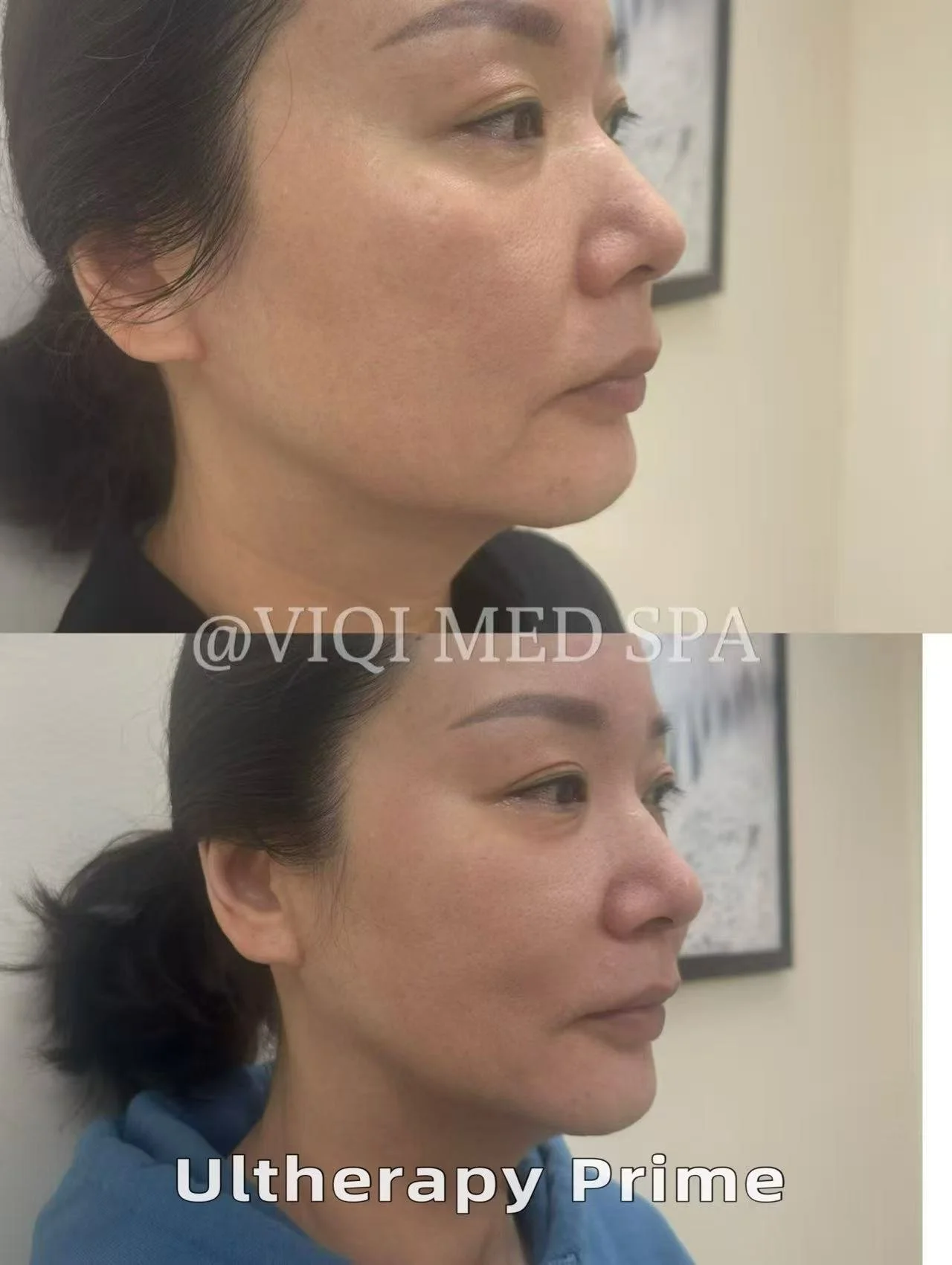 Real VIQI Ultherapy Prime Patient — Before & After. Individual results vary.