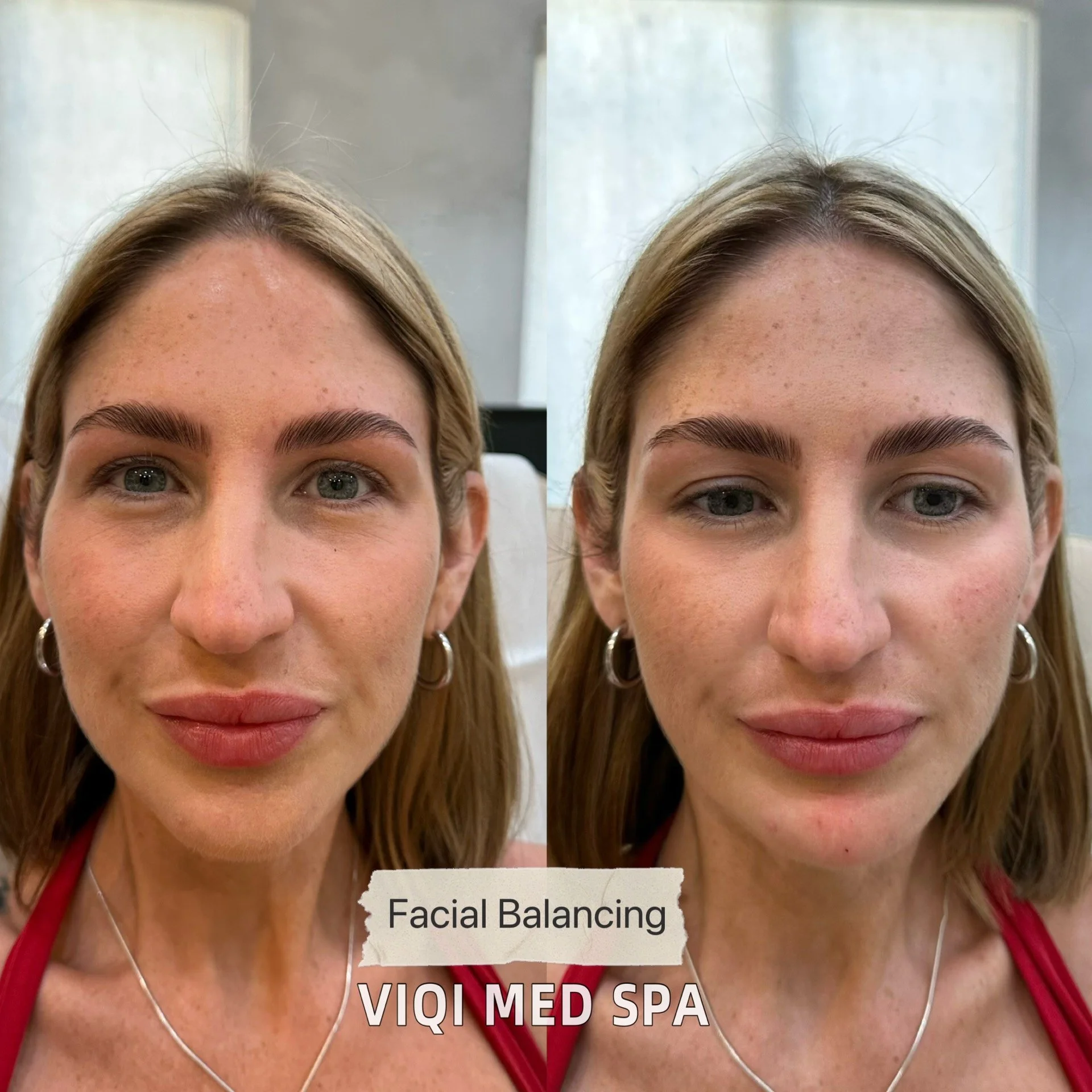 Facial Balancing · Patient Case 02
VIQI Med Spa patient comparison. Individual results vary.
