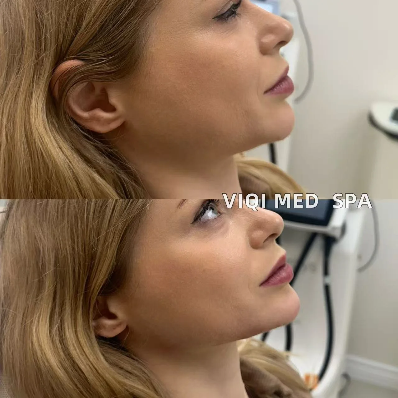 Facial Contour · VIQI Patient Results