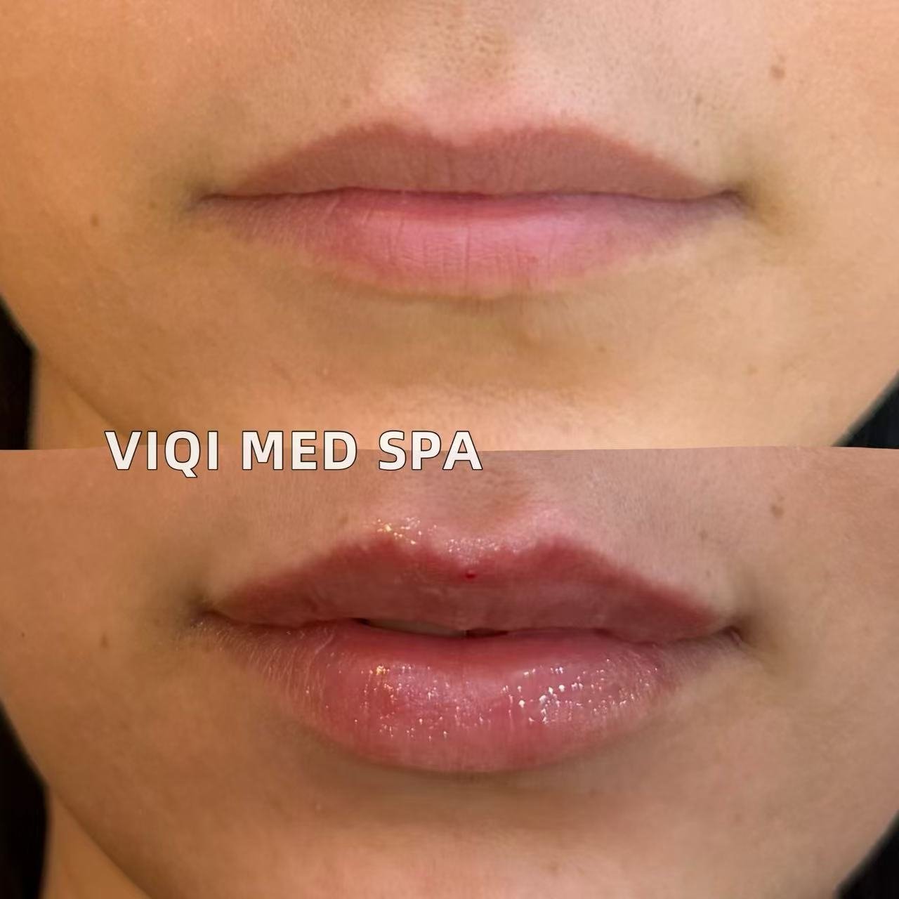 VIQI lip filler comparison, before above and after below