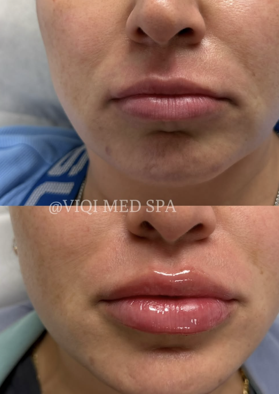VIQI lip filler patient example 1, before on top and after below