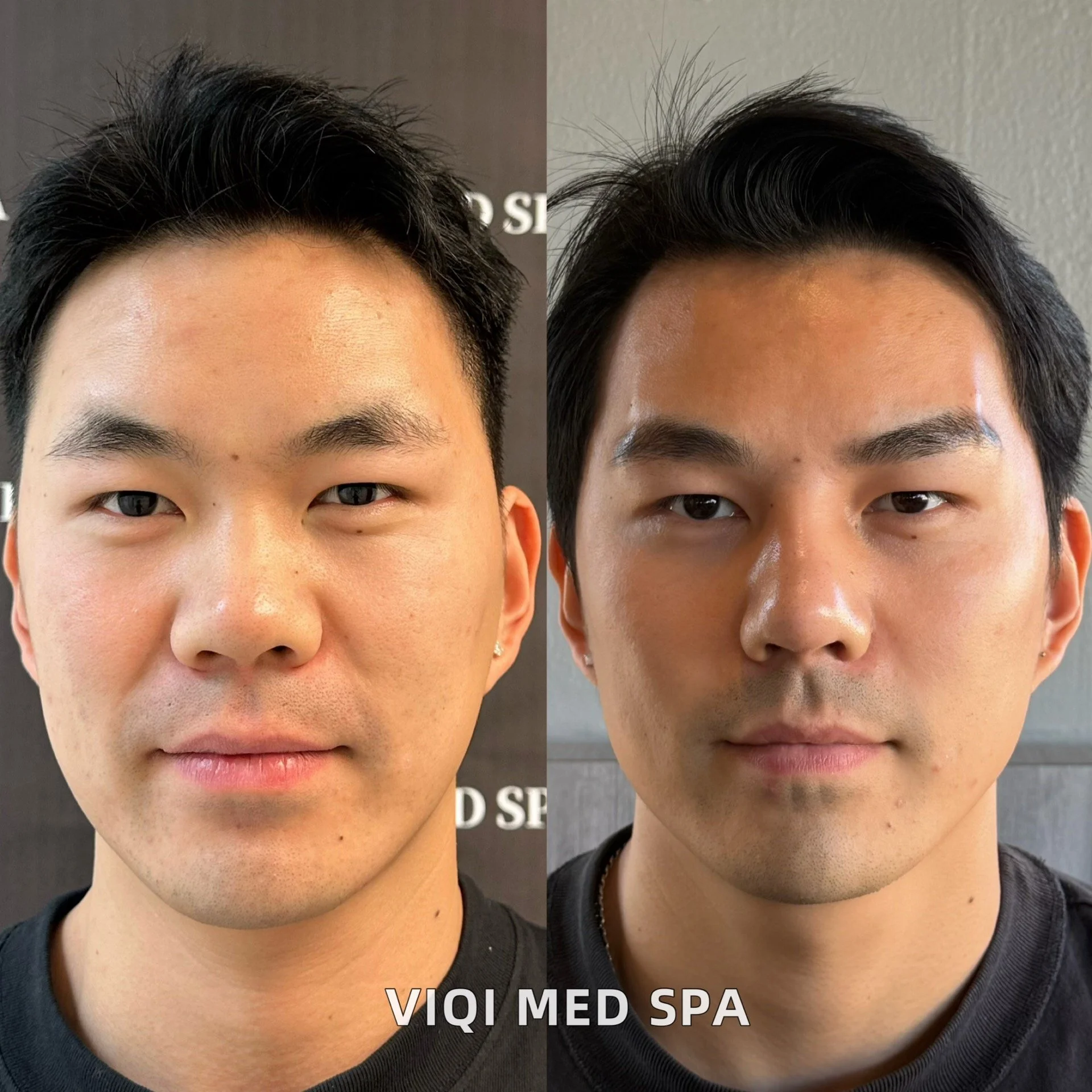 Facial Balancing · Patient Case 03
Treatment planning tailored to your features. Individual results vary.