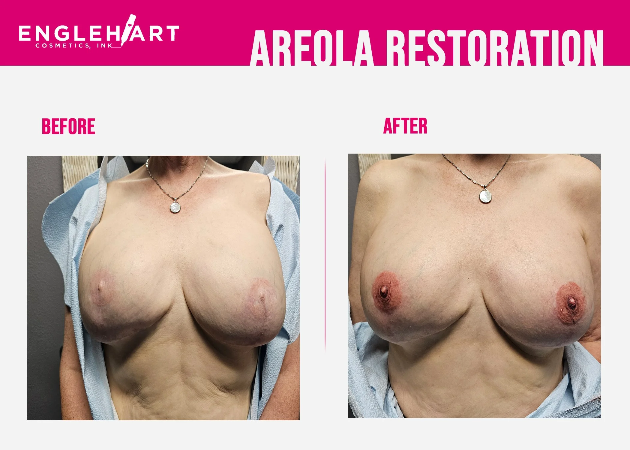 Areola Restoration2.jpg