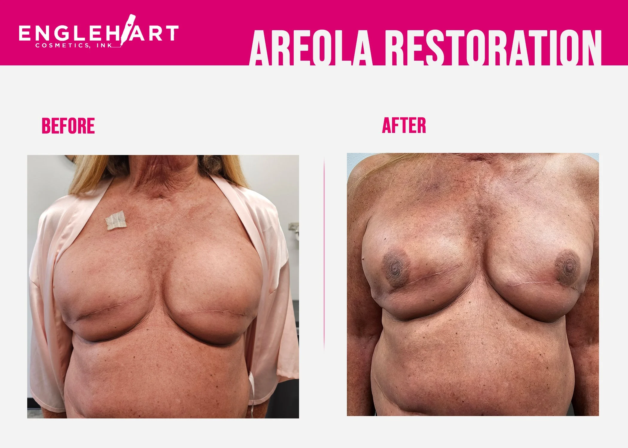 Areola Restoration.jpg