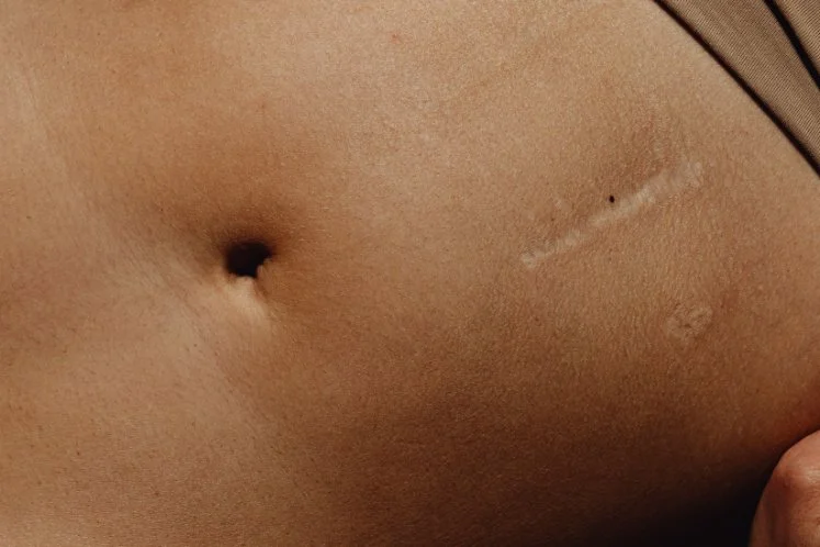 scar release therapy with dolphin kit