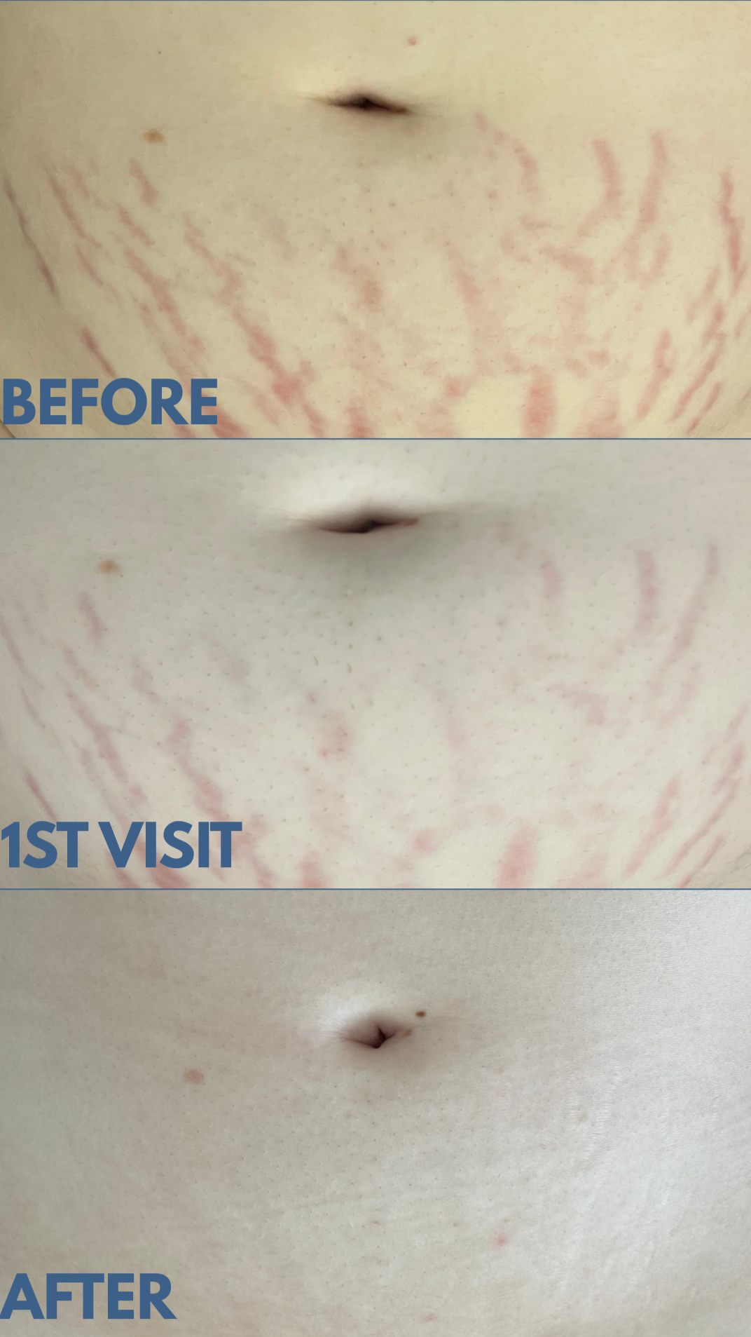 Close-up of a person's abdominal area showing the skin after a cosmetic procedure, with improvements in skin appearance and reduced redness.