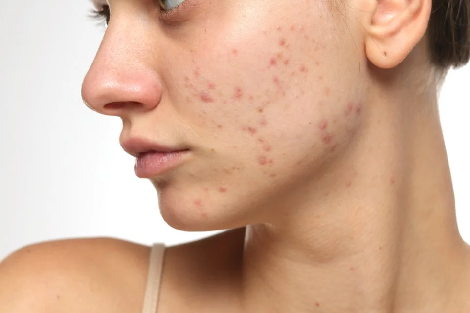 Skin Type
