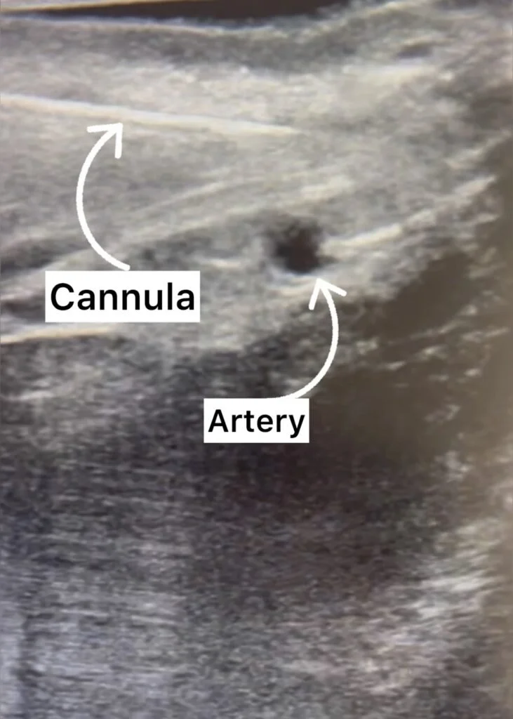 Real-time ultrasound imaging used by Dr. Bita Farrell, MD, to map unique facial anatomy for the highest standard of precision and safety during aesthetic procedures in Westlake Village.