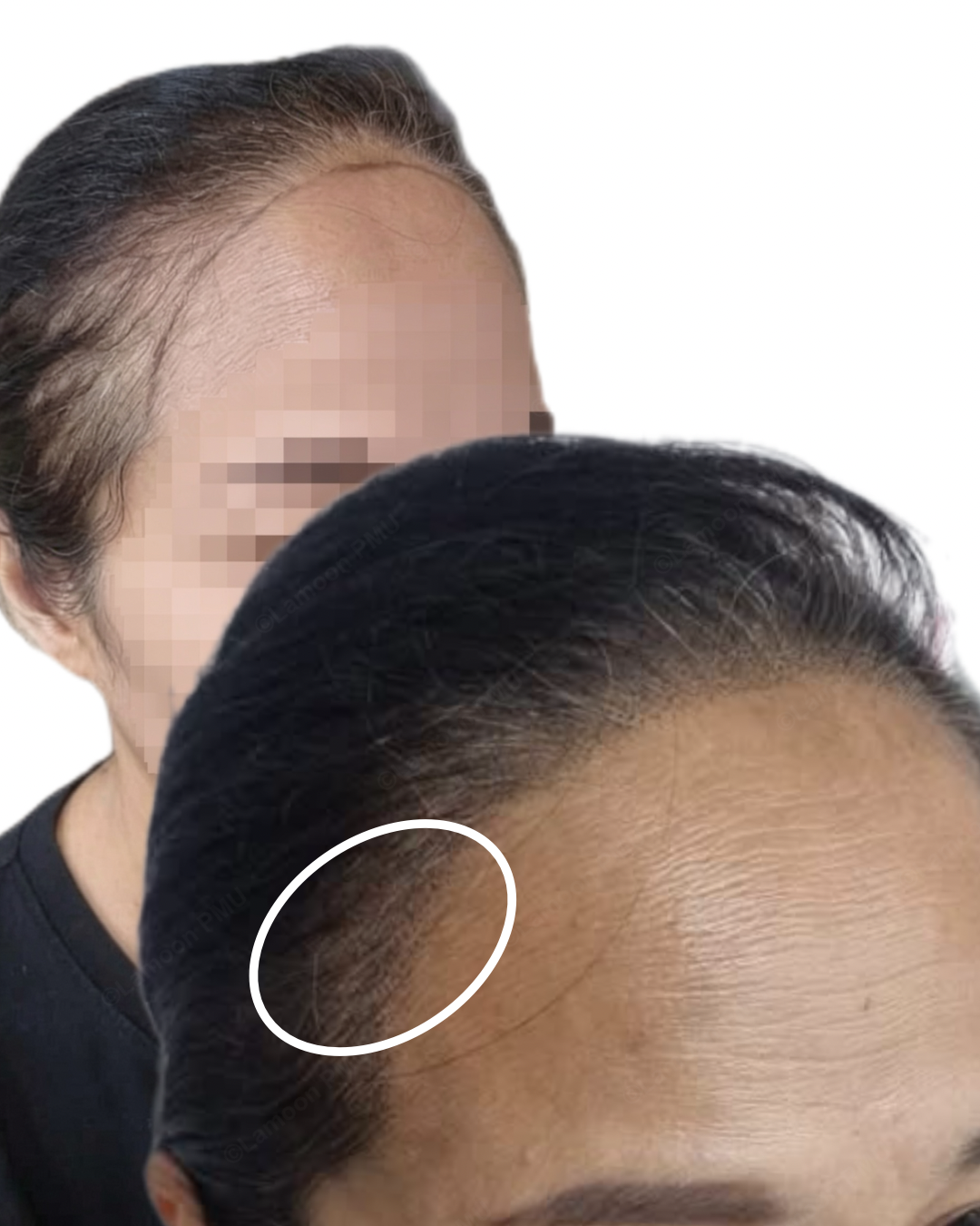 Female hairline correction and edge fill using scalp micropigmentation.