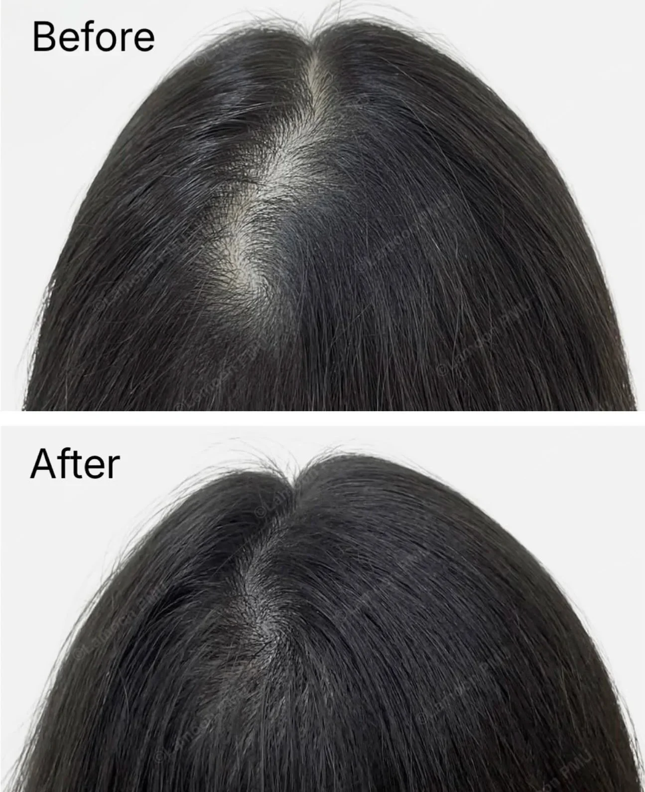 Precision density treatment for thinning hair parts in women.