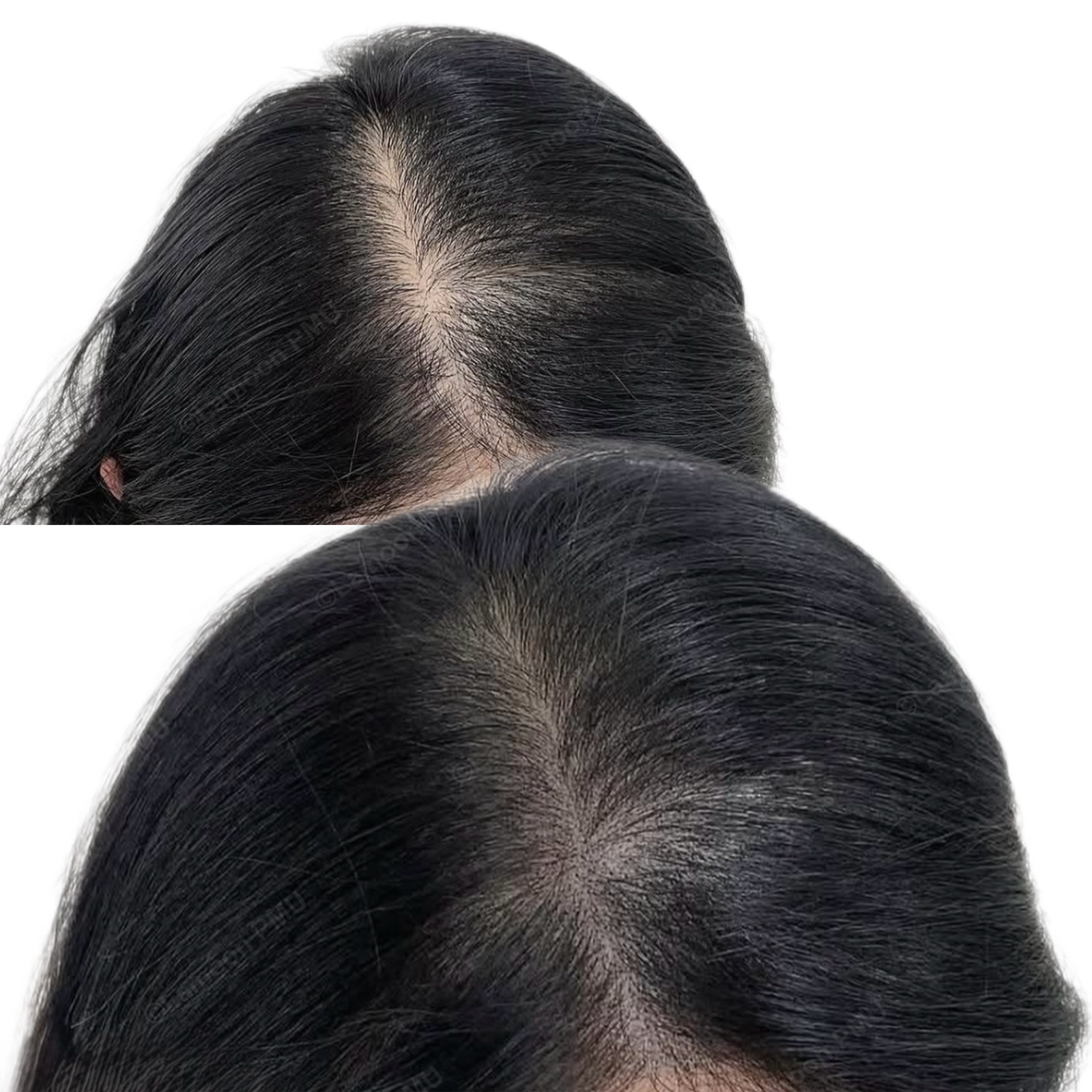 Female side-parting hair loss density fill with scalp micropigmentation.