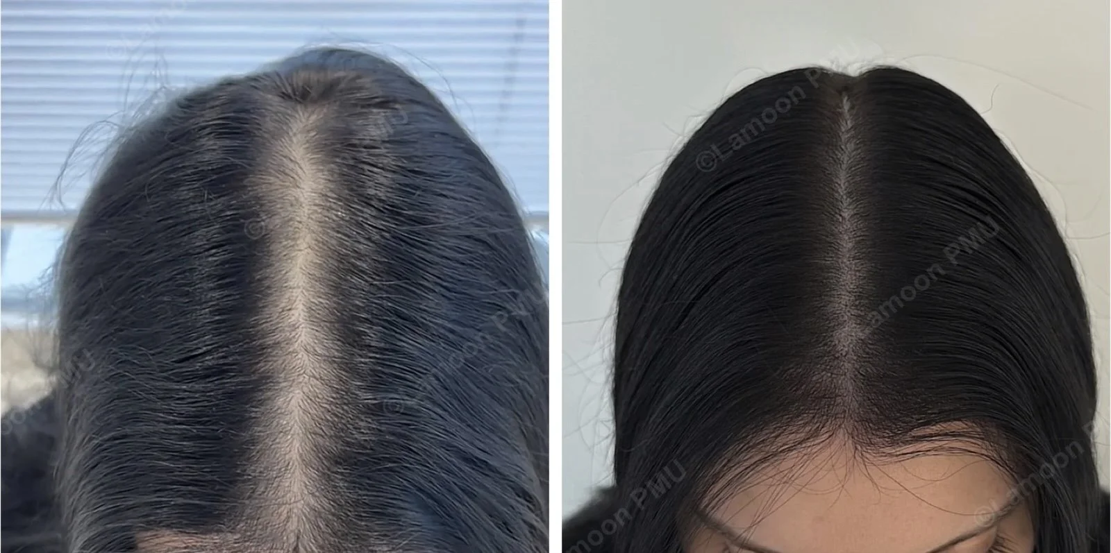 Dark hair female scalp micropigmentation before and after filling in wide hair part line.