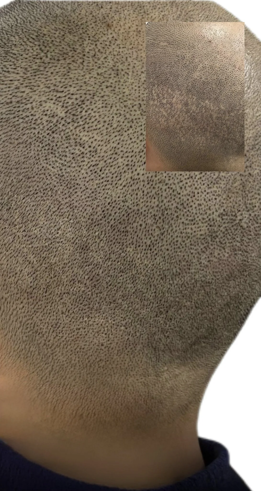 Close-up of natural hair follicle impression created by scalp micropigmentation on a scar head