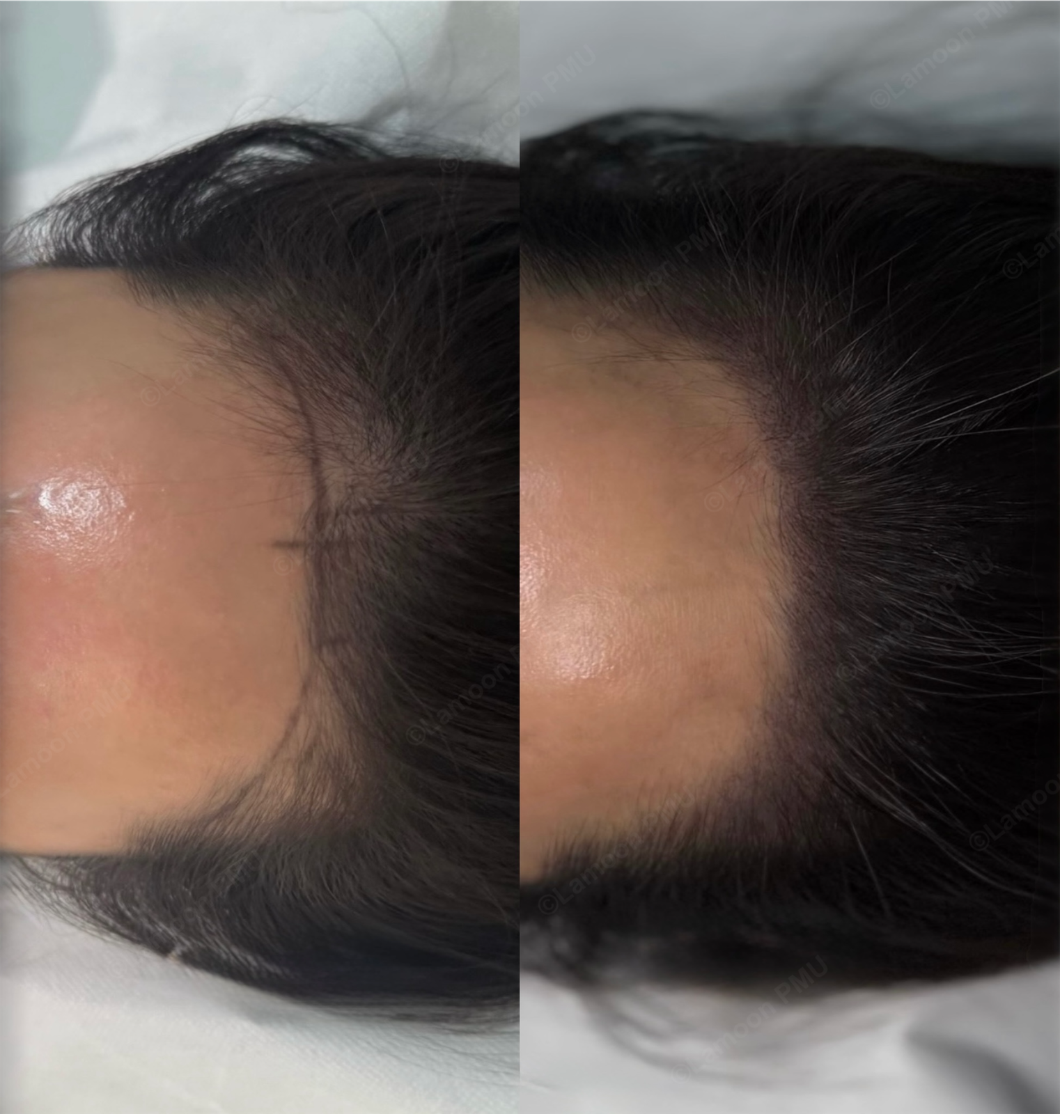 Before and after scalp micropigmentation showing natural hairline density restoration on a female client.
