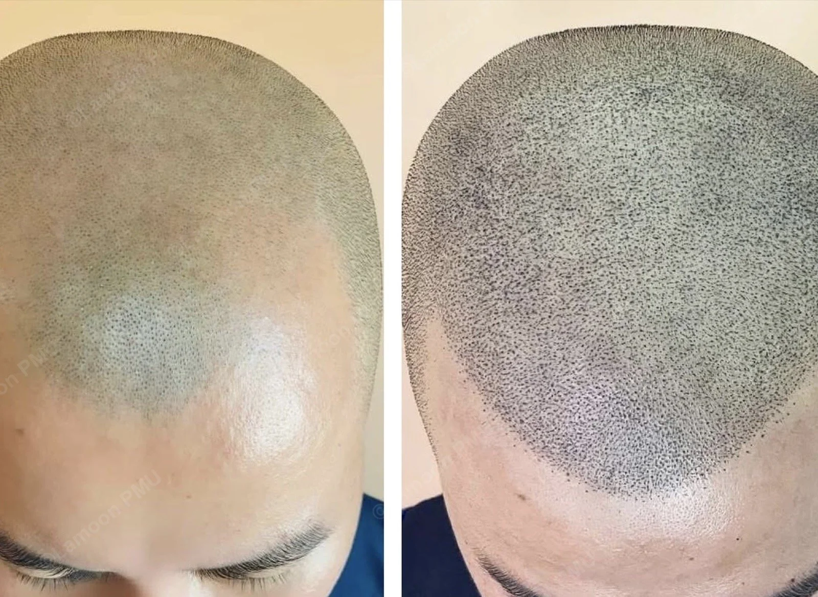 Top angle view of shaved head scalp micropigmentation density and hairline shaping.