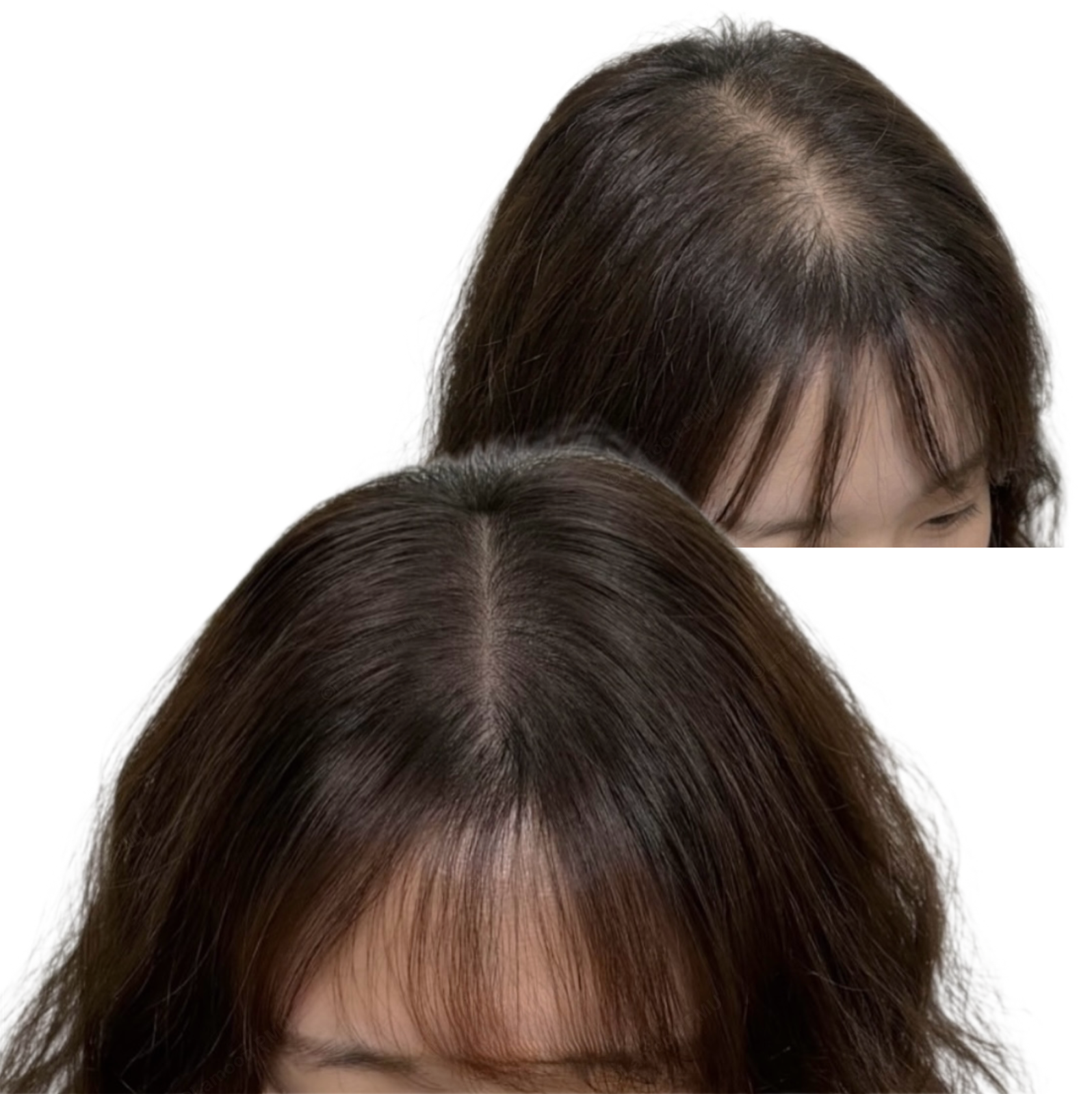 Top-down view of female scalp micropigmentation filling thinning crown and part line.
