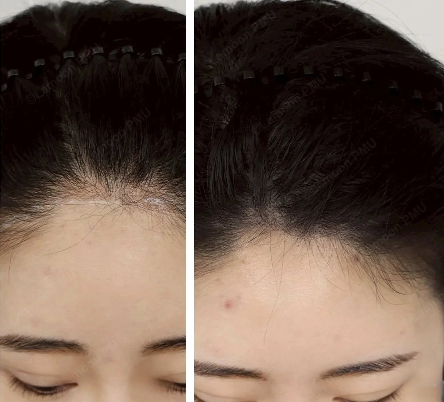 Female temple edge hair loss filled using subtle scalp micropigmentation.