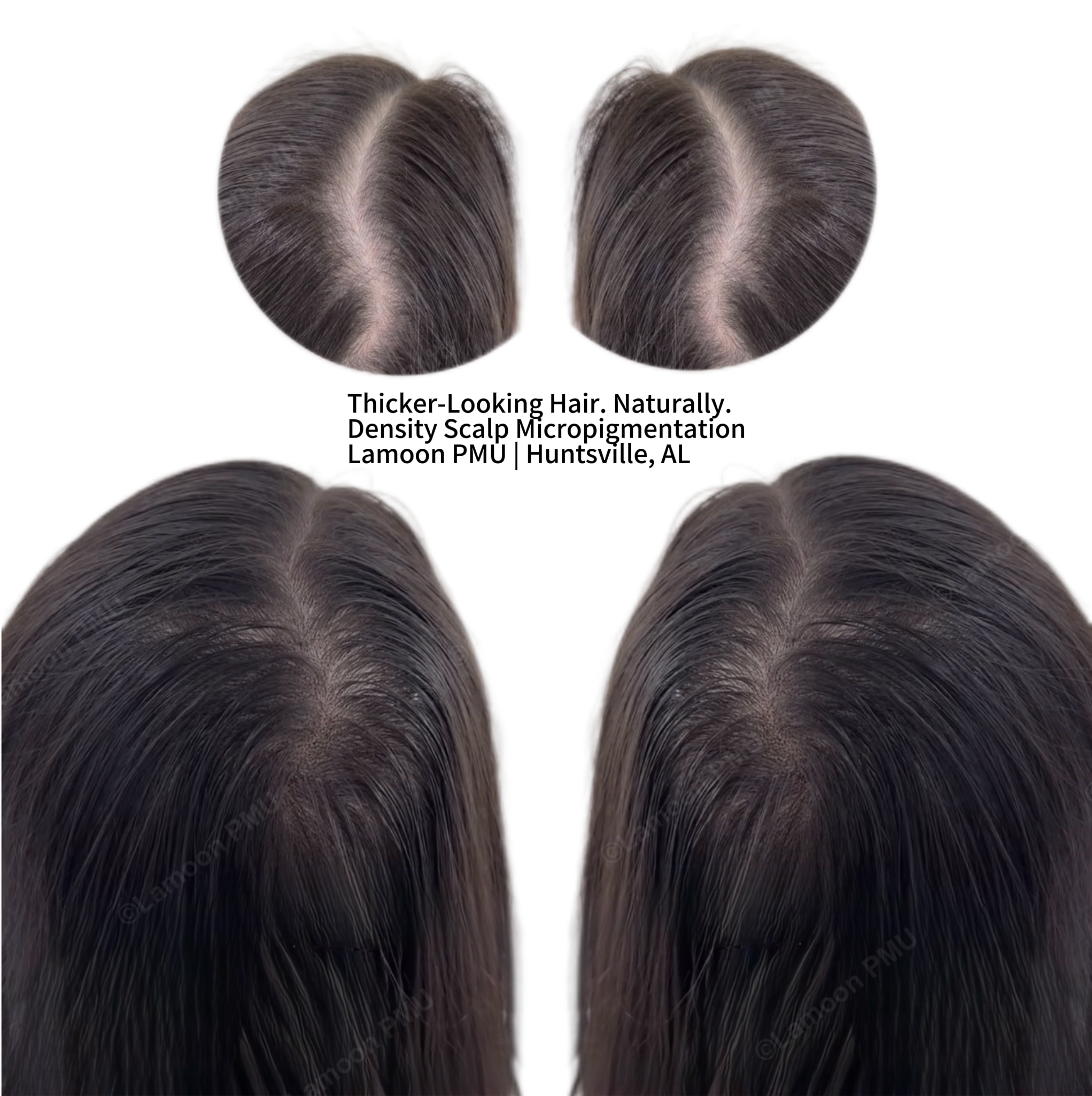 Thicker-looking hair naturally after having density scalp micropigmentation.