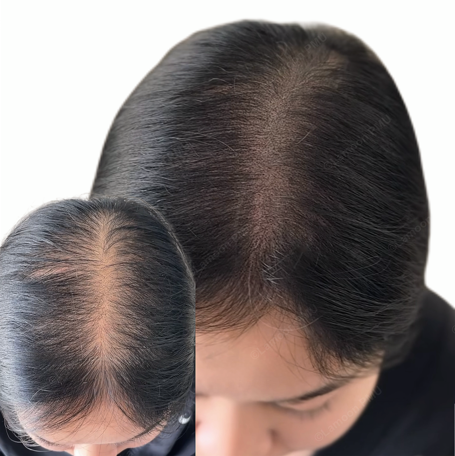 Female hair loss treatment with scalp micropigmentation on thinning area.