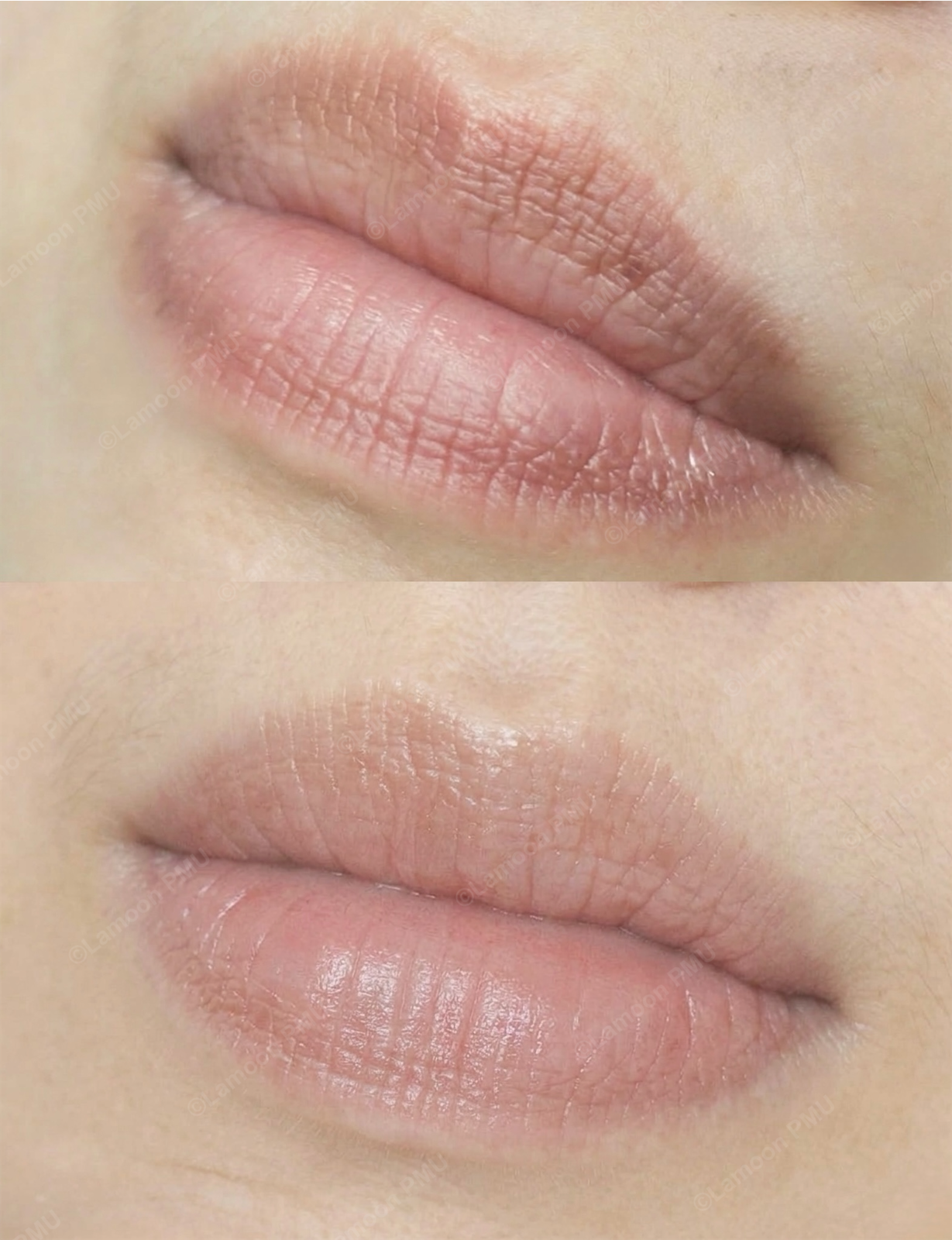 Lip neutralization to even out cool or dark tones, restoring a bright, soft pink color and creating natural definition.