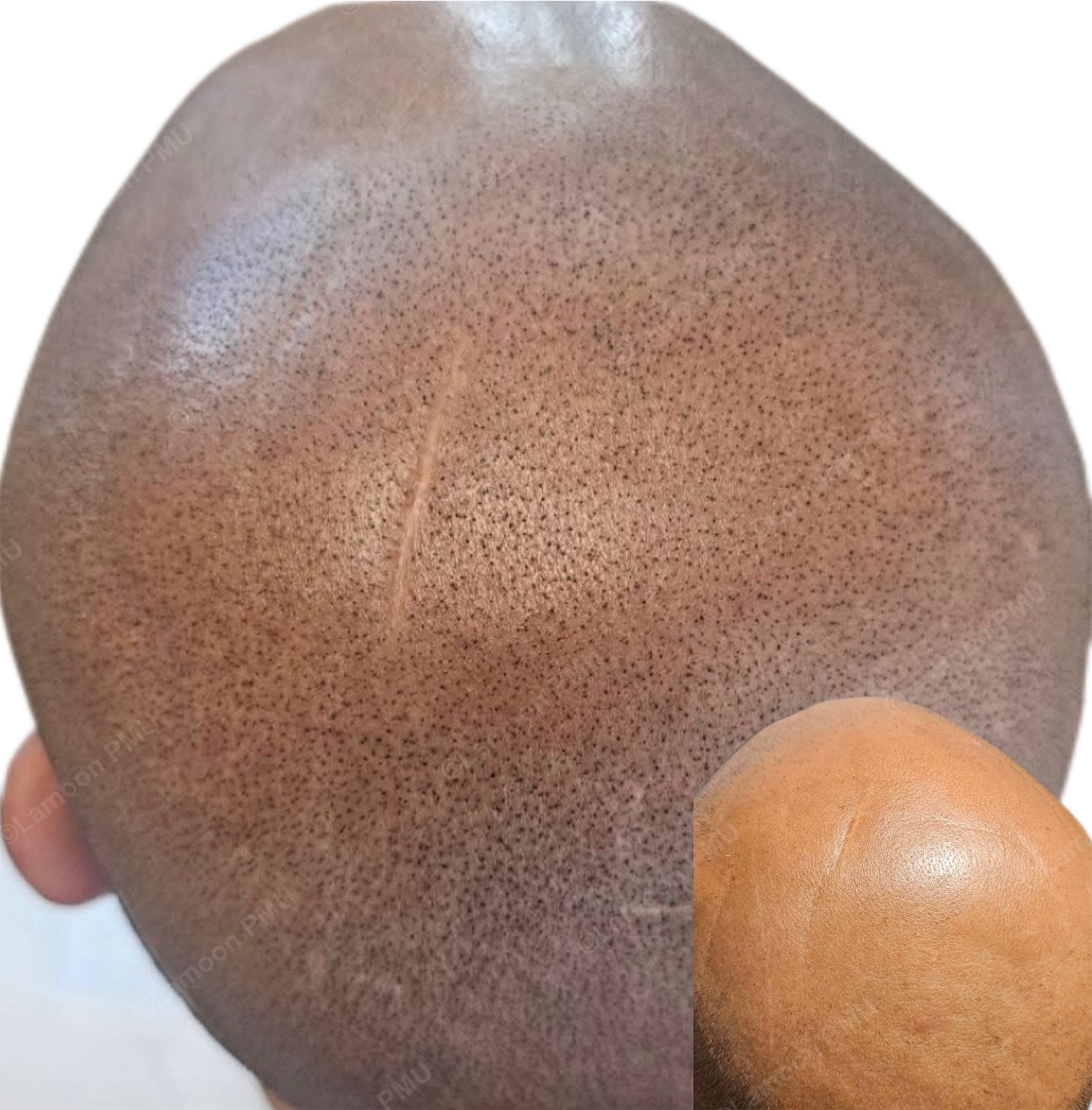 Full head scalp micropigmentation transformation for total male pattern baldness.