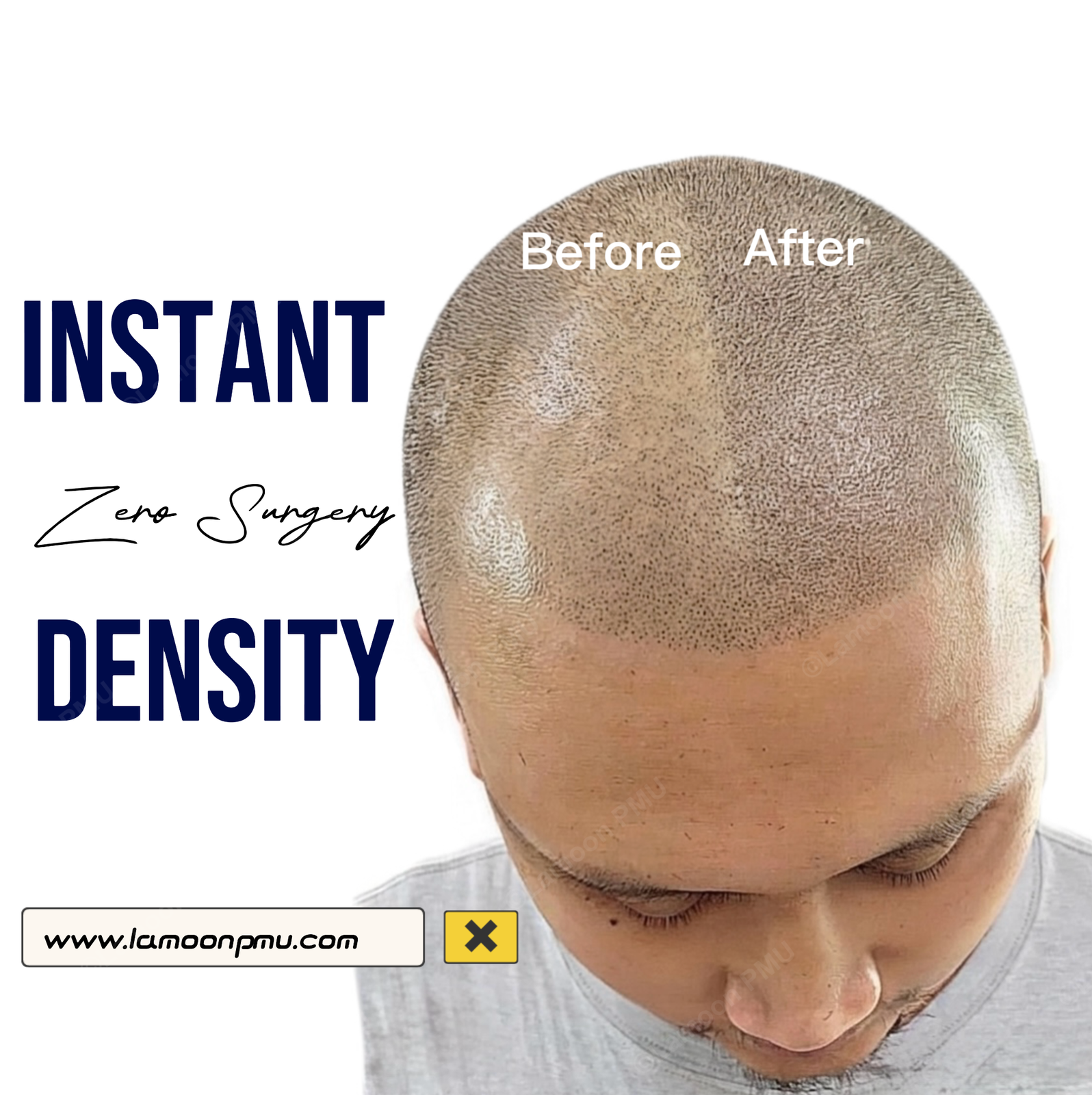 Instant zero surgery density scalp micropigmentation before and after on shaved male head.