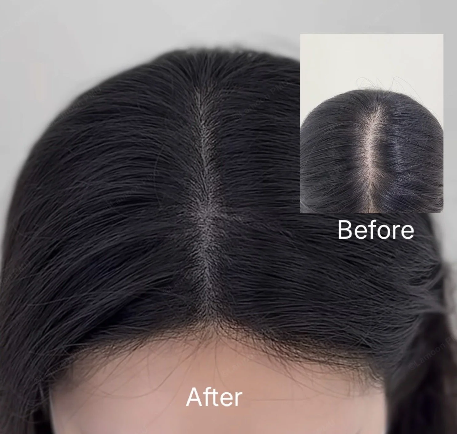 High contrast before and after female scalp micropigmentation on center part line.