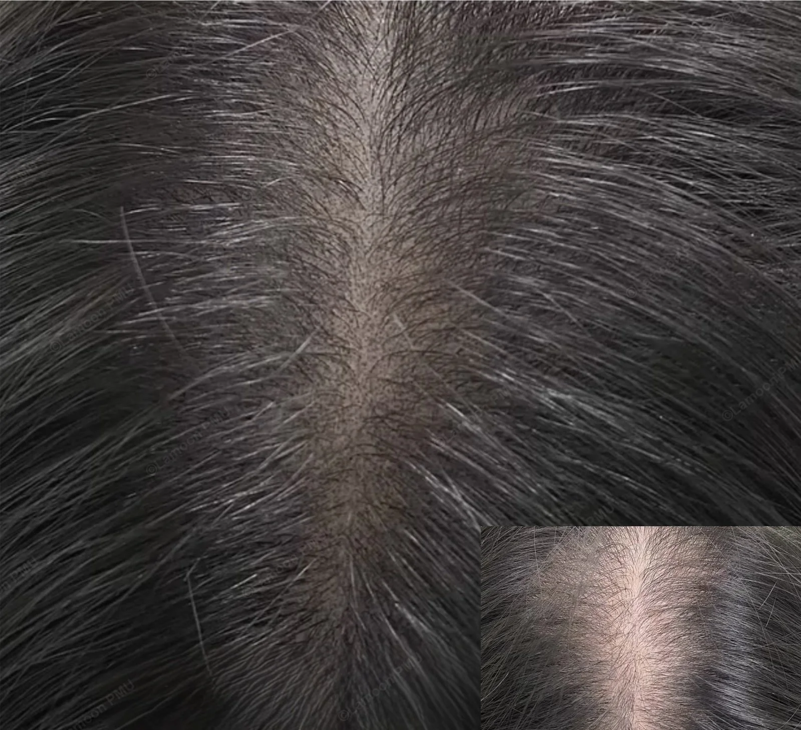 Scalp micropigmentation before and after inset showing scalp concealment on dark hair.