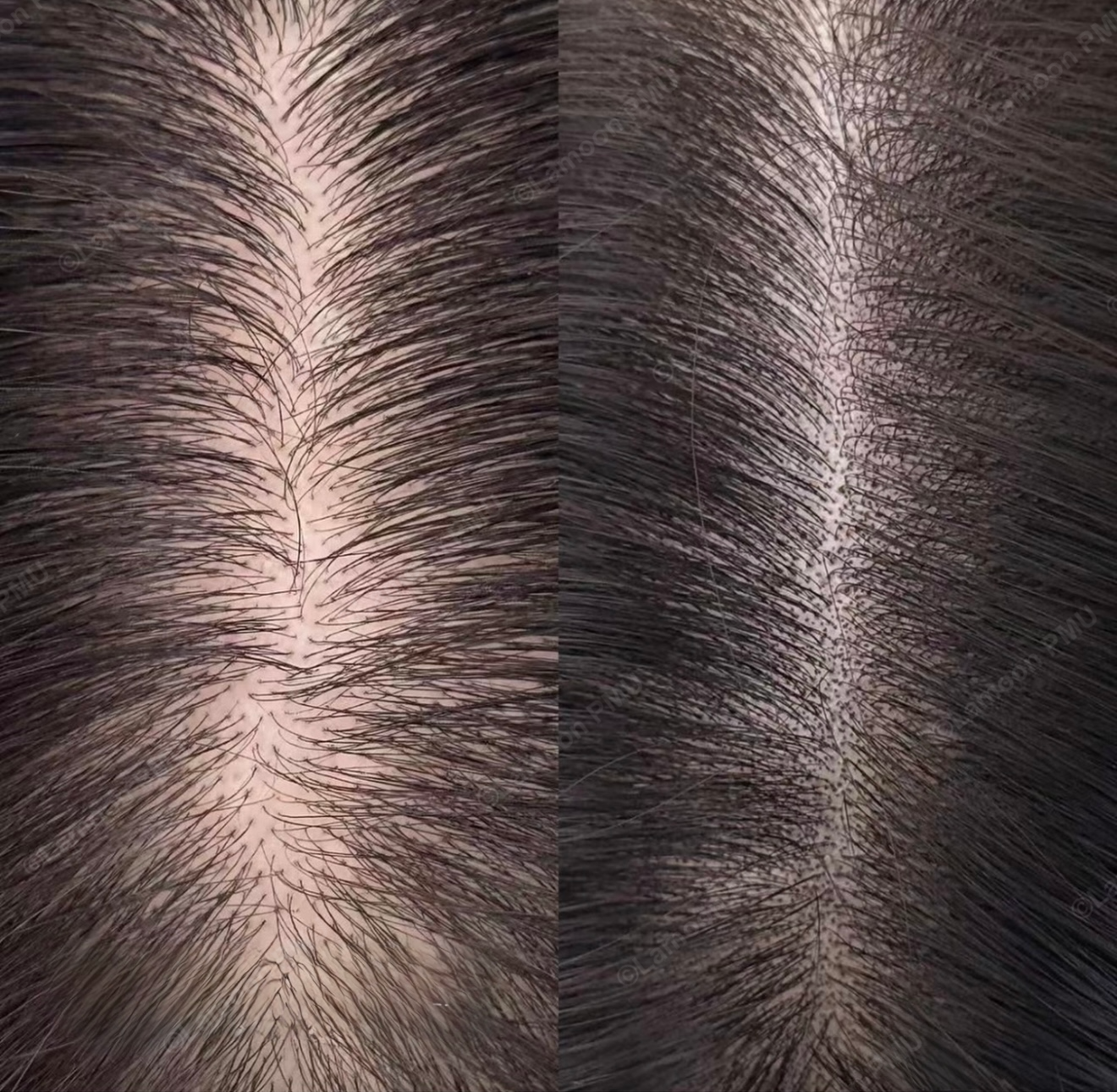 Detailed close-up of scalp micropigmentation impressions reducing scalp contrast along part line.