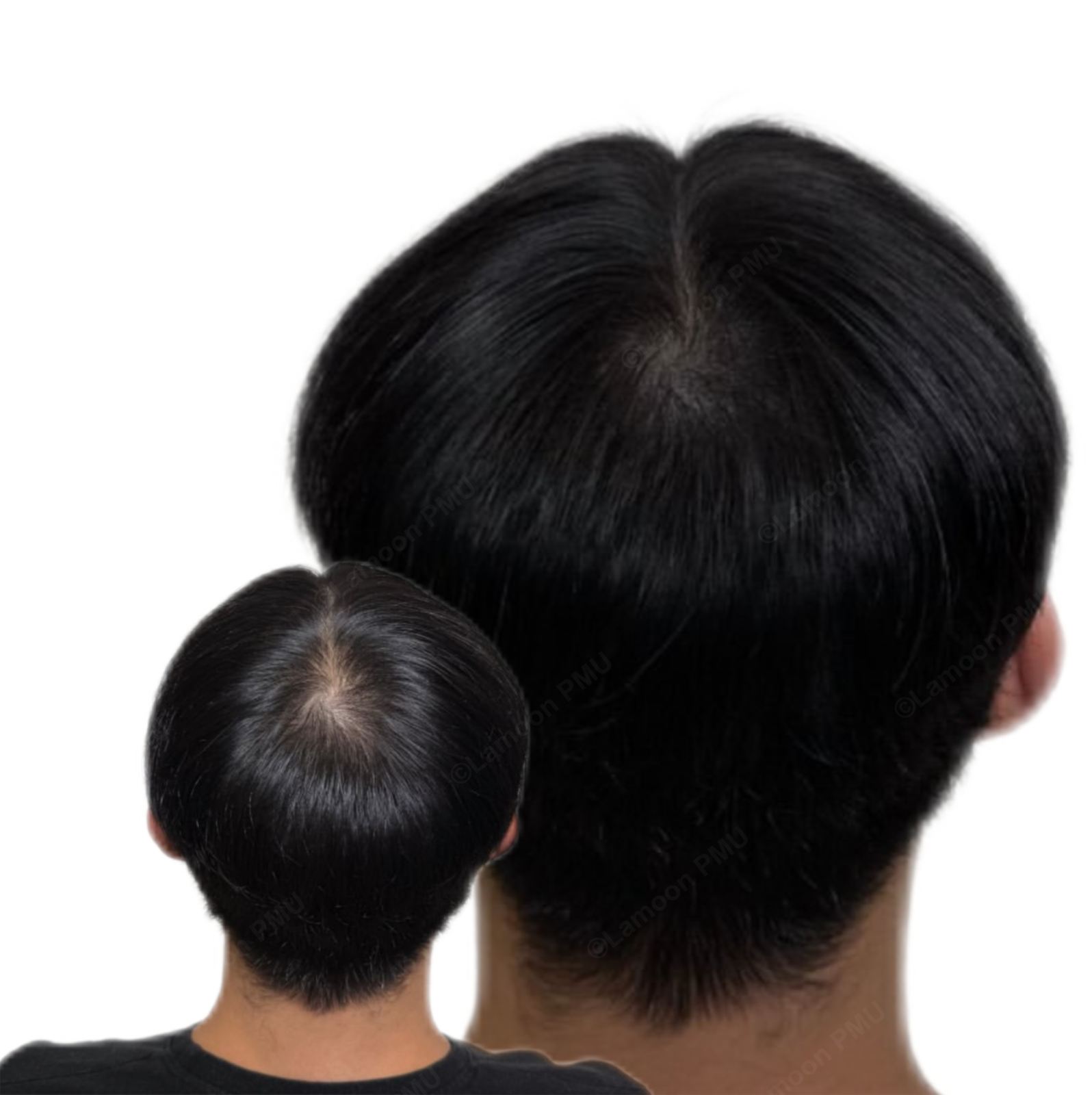 Male scalp micropigmentation for crown thinning coverage.