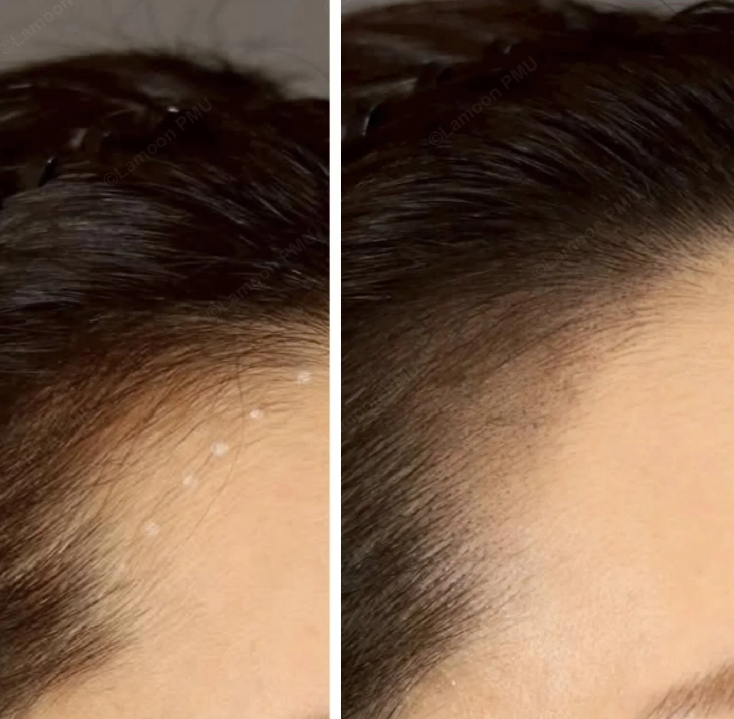 Subtle scalp micropigmentation along temple and front hairline area.