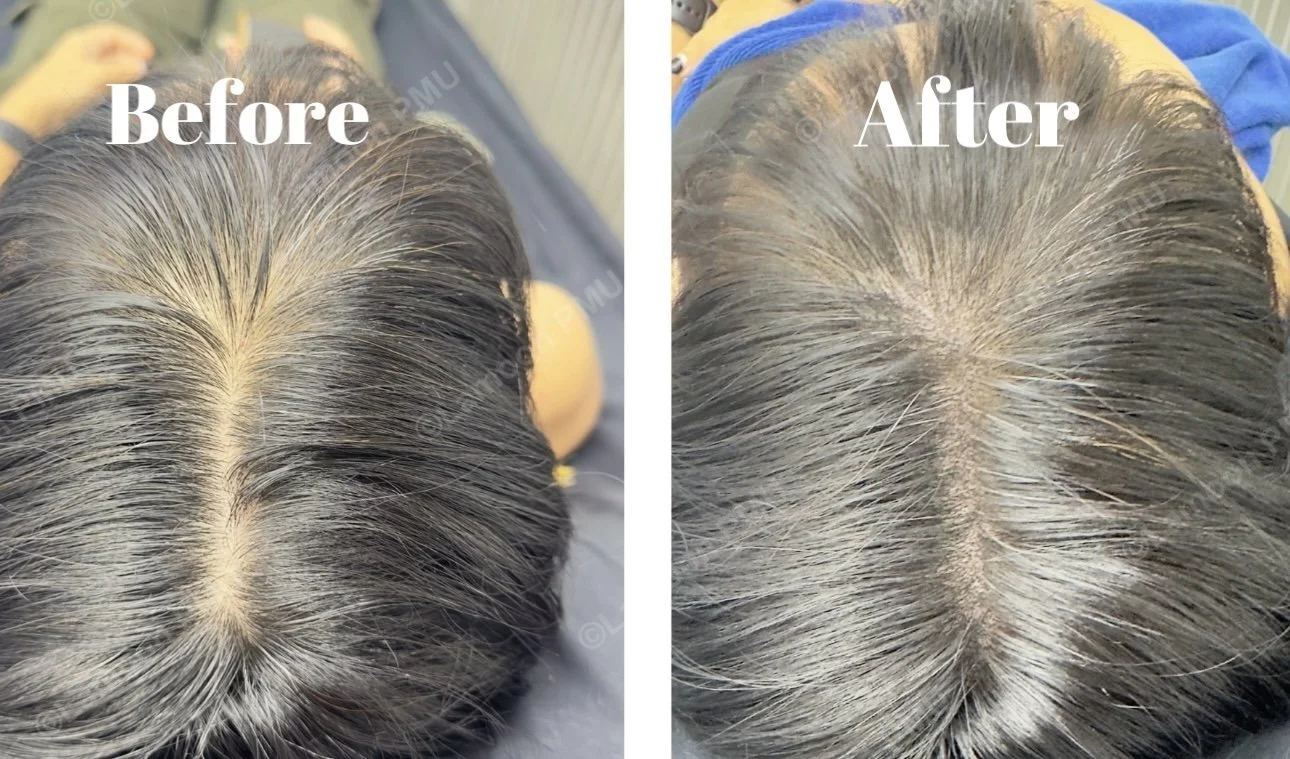 Scalp micropigmentation applied to hair part line for natural scalp coverage.