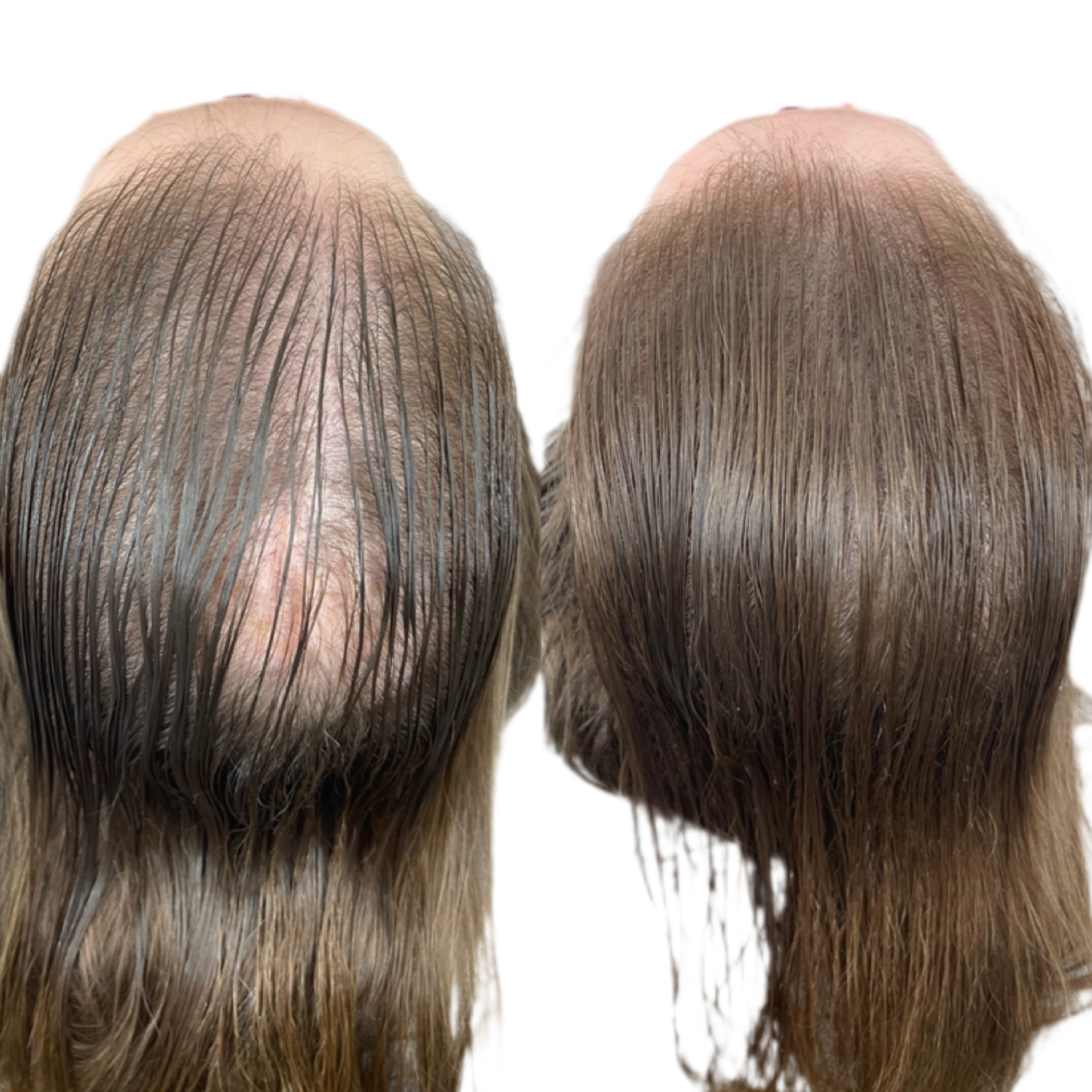Scalp micropigmentation for long hair density fill reducing scalp visibility on top of head.