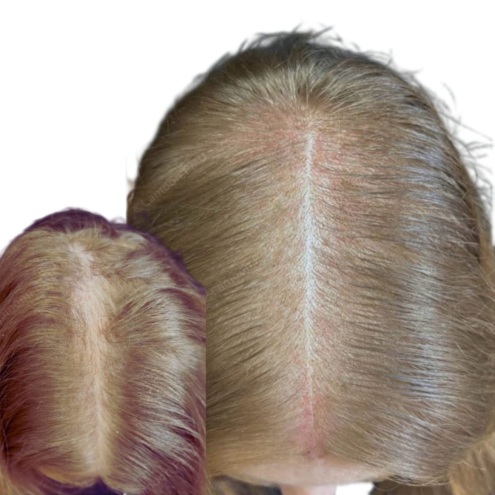 Female scalp micropigmentation density result on blonde/light brown hair parting line.