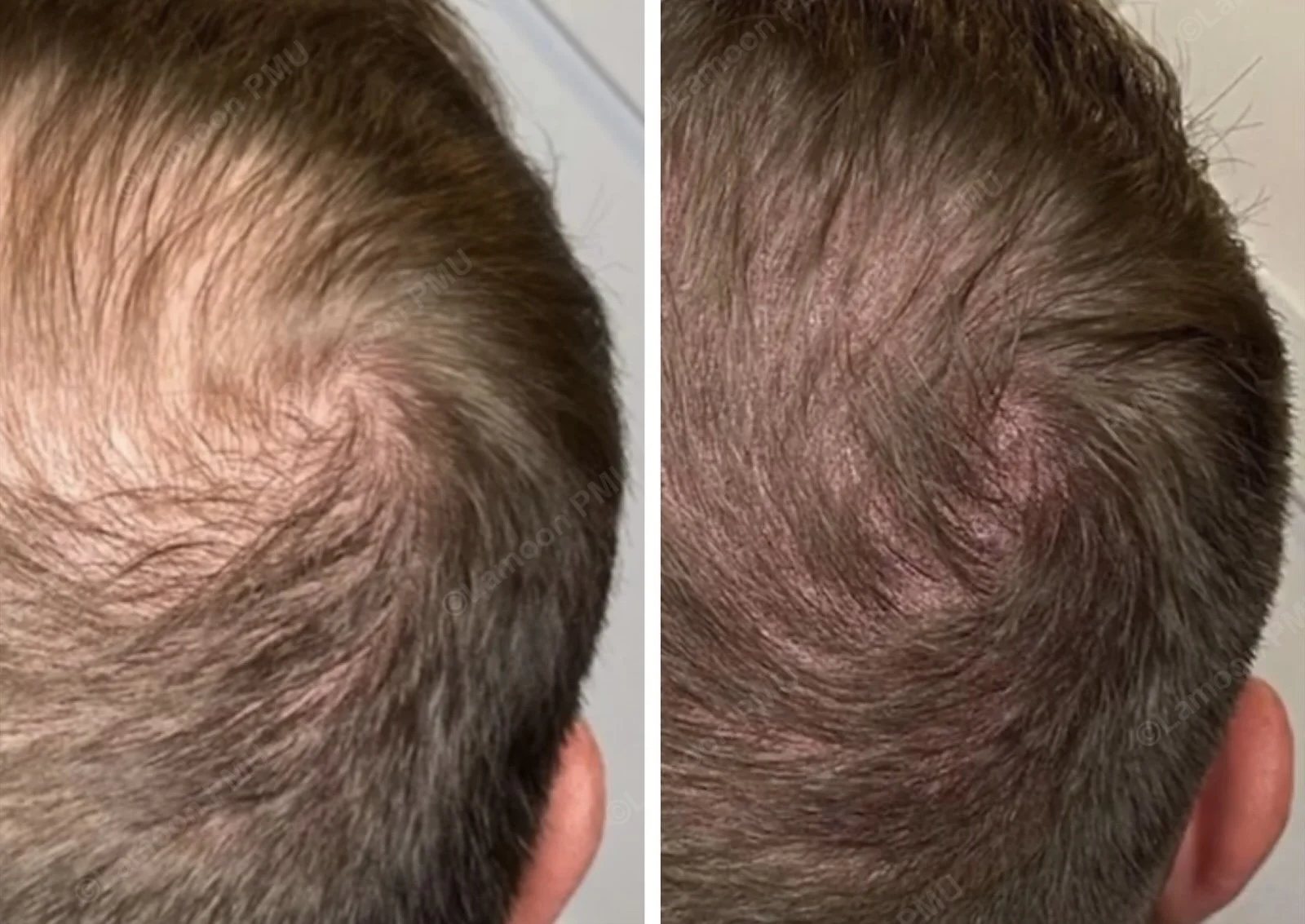 Scalp micropigmentation for men's crown hair loss before and after density fill.