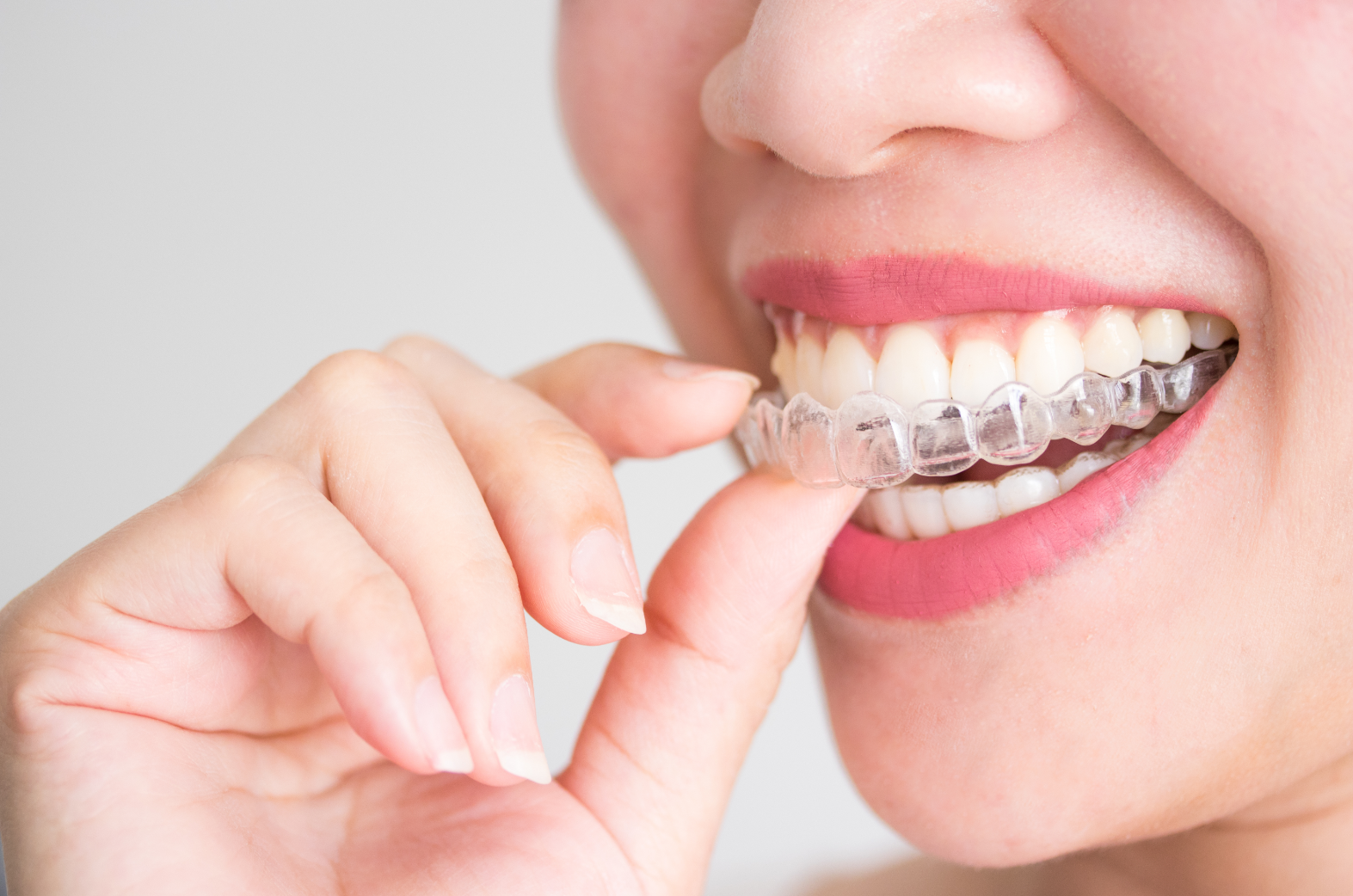 Adult clear aligner treatment in Crows Nest