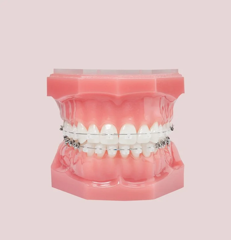 Ceramic braces for a more discreet look