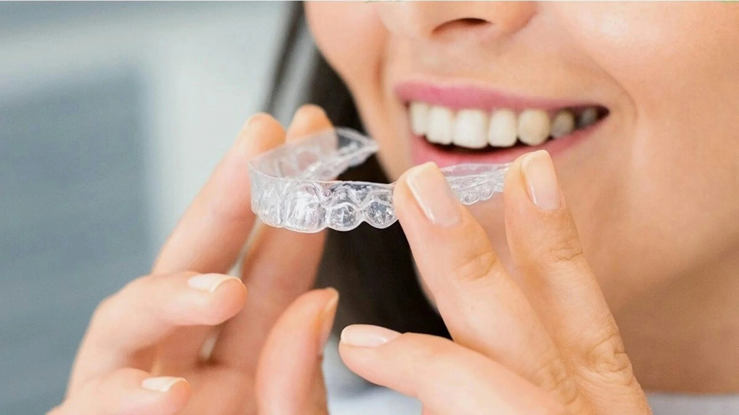 Removable clear aligners for everyday life
