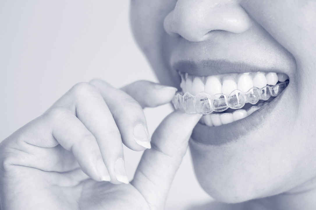 Clear aligner treatment at Shore Orthodontics, Crows Nest
