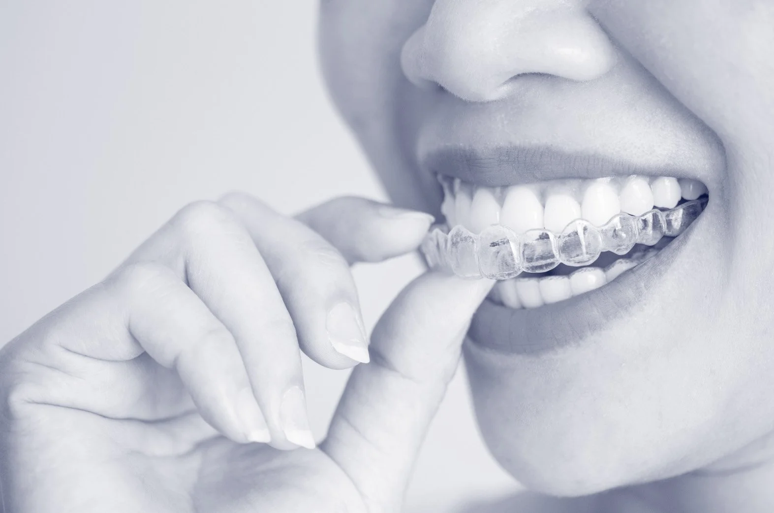 Clear aligner treatment at Shore Orthodontics
