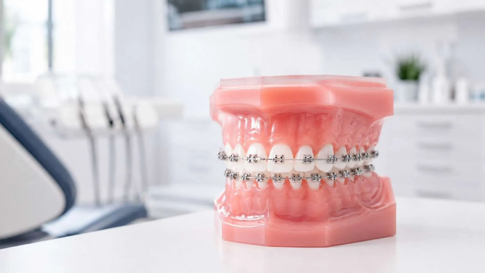 Orthodontic braces model showing fixed braces, used to explain braces treatment at Shore Orthodontics in Crows Nest.