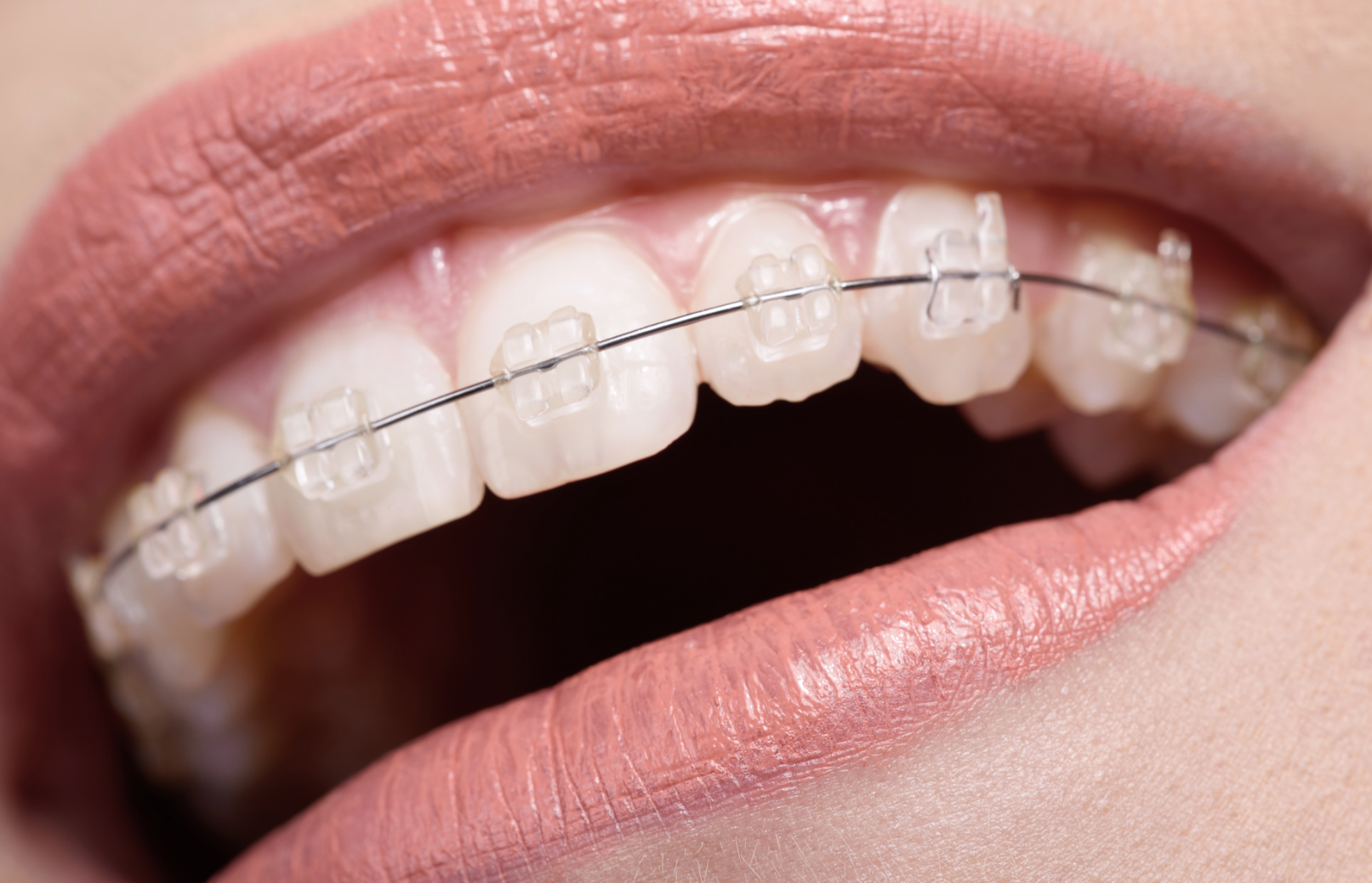 Adult clear braces treatment in Crows Nest