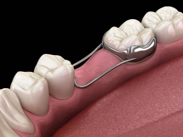 Space maintainer to preserve room for adult teeth