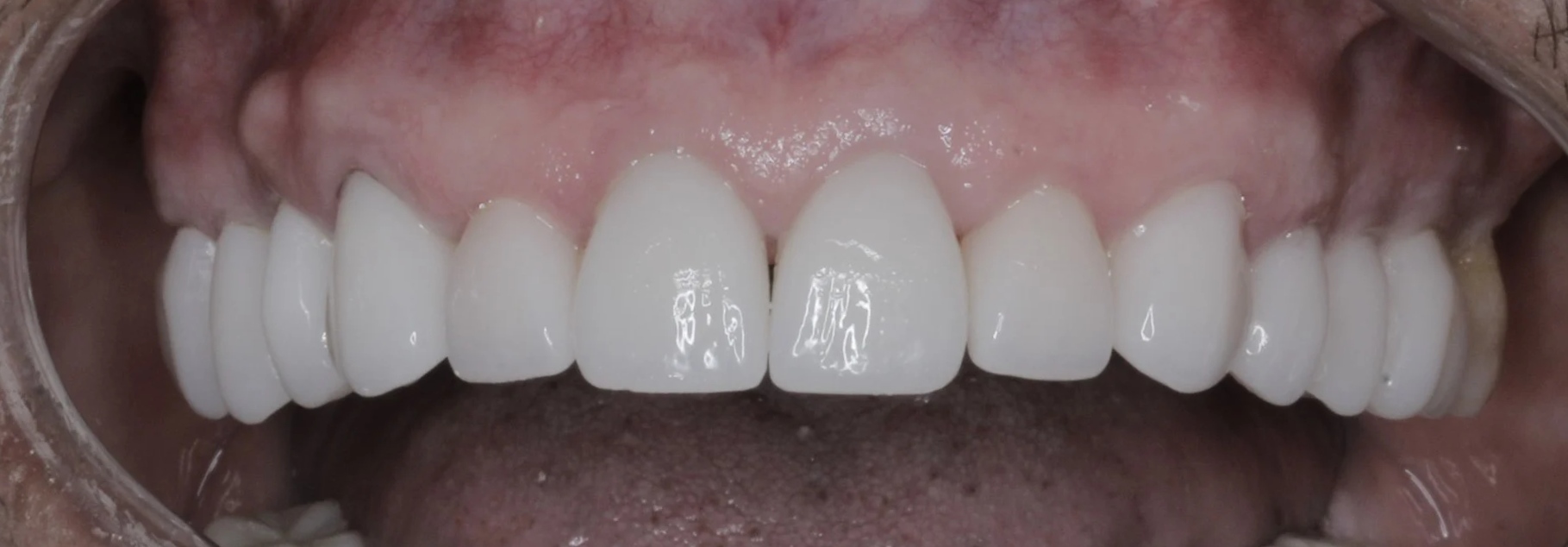 Nuevas coronas y carillas libres de metal de todos los dientes superiores.