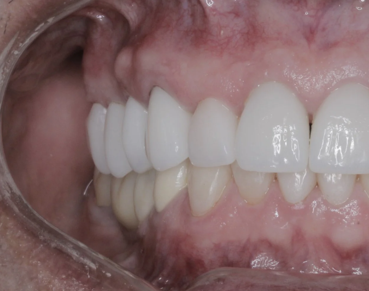 Después 
Reemplazo de puente fijo + coronas 